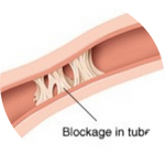 Tubal Blockage 