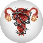 Endometriosis