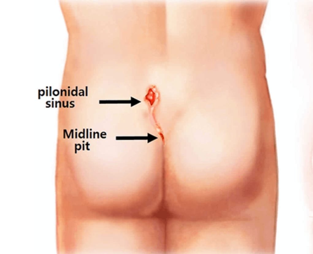 Pilonidal Sinus 