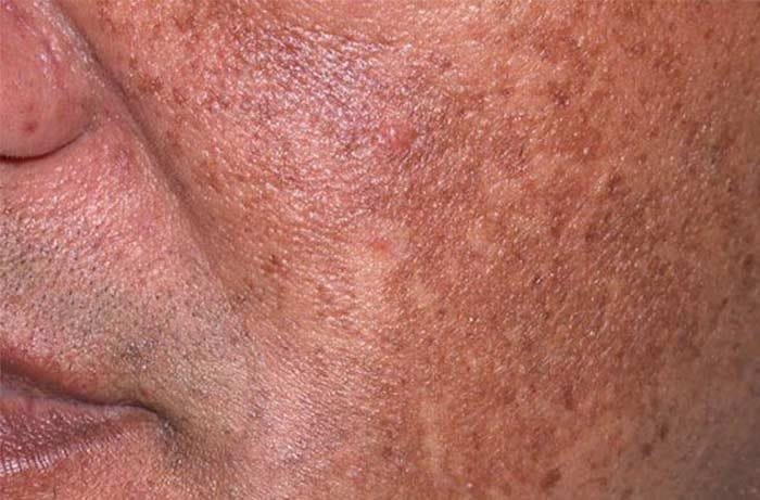Hyperpigmentation 