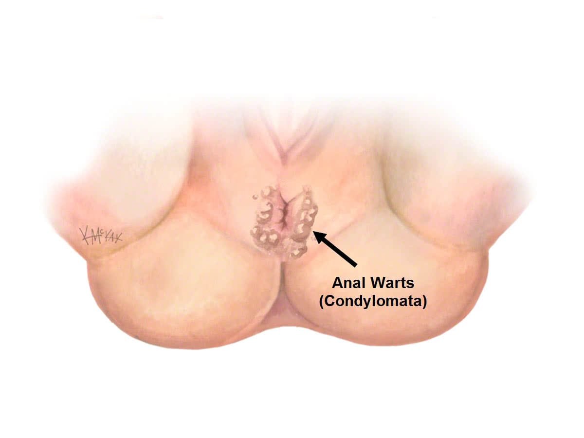 Anal Wart 