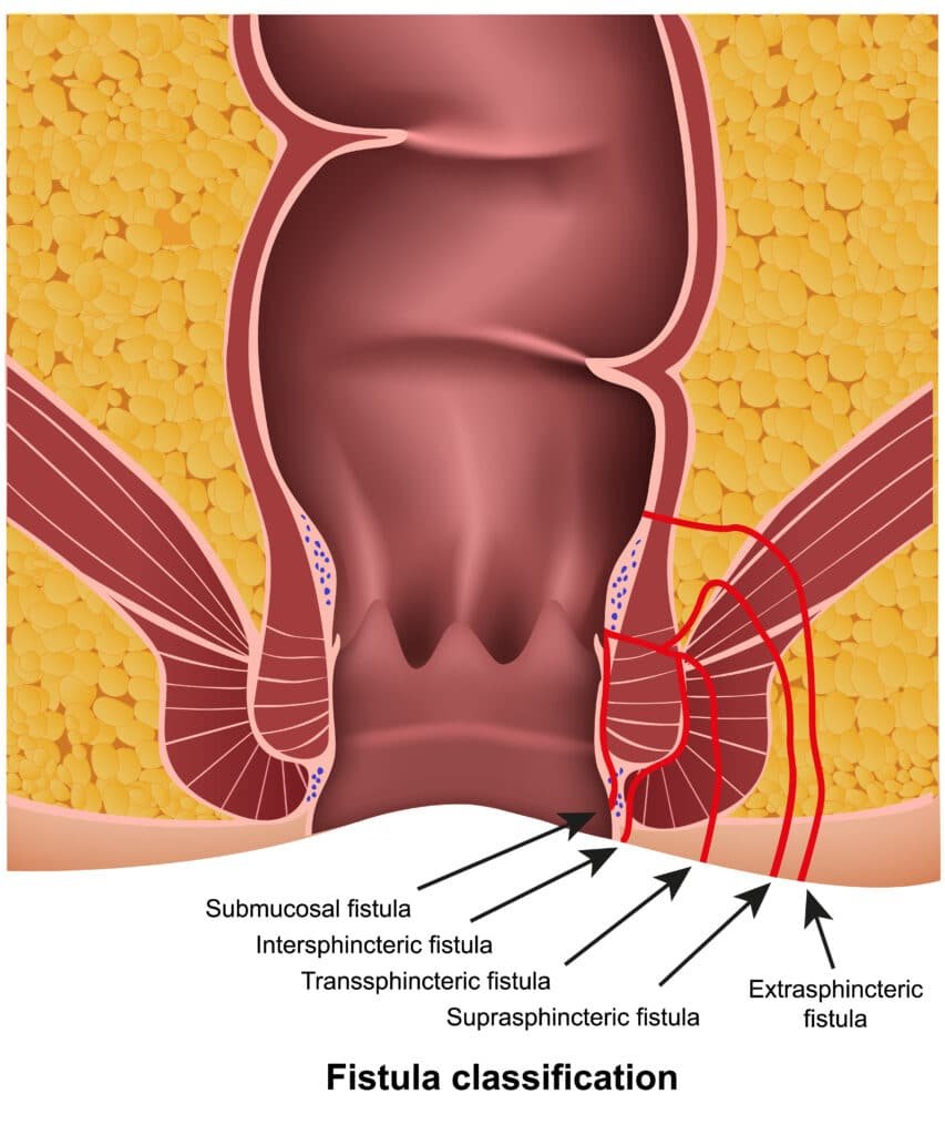 Fistula 