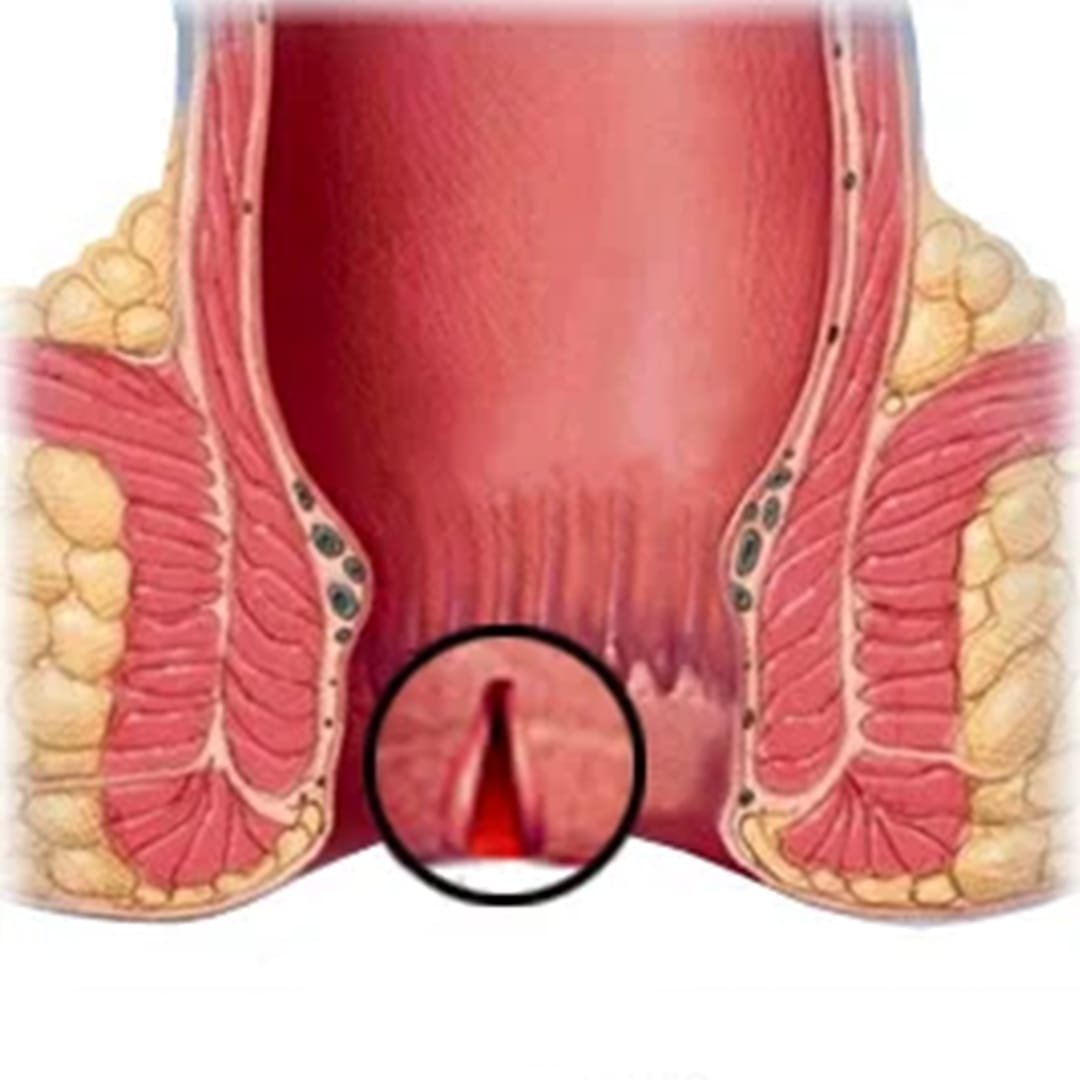 Fissure 